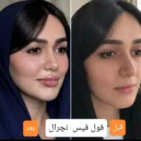 جشنواره پک مادلینگ +بوتاکس رایگان(فک لب گونه چانه)|خدمات آرایشگری و زیبایی|قم, زنبیل آباد|دیوار