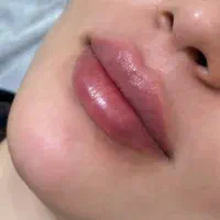 فیلر و بوتاکس|خدمات آرایشگری و زیبایی|اهواز, کیانپارس |دیوار