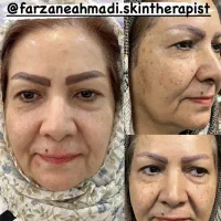 درمان کک ومک/جای جوش/خال/لک/بخیه
