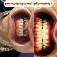 ایمپلنت دیجیتال|خدمات آرایشگری و زیبایی|قم, نیروگاه|دیوار