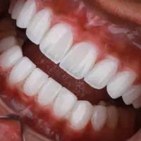 فرصت ویژه ونیر کامپوزیت