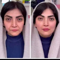 مرکز تخصصی جوانسازی فقط در ۱ جلسه/هایفو/لیفت ۸۹۰ت