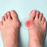 کلینبک درمان هالوکس والگوس (شصت پای کج)|خدمات آرایشگری و زیبایی|قروه, |دیوار