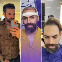 کاشت مو ابرو مزو و پی آر پی بوتاکس