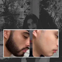 ریش مو ریزشَ سکه ای