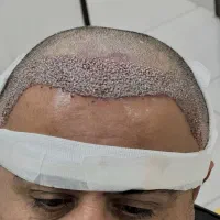 آموزش و کاشت مو به روش FIT