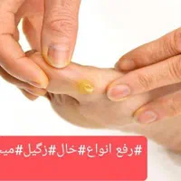 کلینیک لیزر کرایو زگیل خال میخچه حجامت زالو بوتاکس|خدمات آرایشگری و زیبایی|شیراز, حافظیه|دیوار