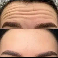 تزریق بوتاکس