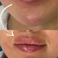 تزریق ژل و بوتاکس و جوانساز و مزوژل فقط هزینه مواد|خدمات آرایشگری و زیبایی|تهران, ونک|دیوار