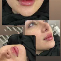 تزریق ژل وبوتاکس مزو ژل پی ارپی توسط پزشک (کلینیک)