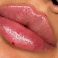 تخفیف ژل ‌‌لب،بوتاکس،زاویه سازی در کلینیک 650