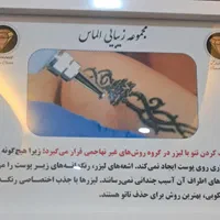 حذف انواع تتو توسط لیزر در کلینیک زیبایی الماس|خدمات آرایشگری و زیبایی|کرج, مهرویلا جنوبی|دیوار