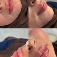 ژل‌وبوتاکس