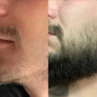 با دو تا دونه مو پز نده
