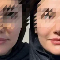 تزریق ژل ، مزوژل فیلر بوتاکس، برداشت  غبغب