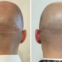 به یک مدل برای میکرواسکالپ کف سر نیازمندیم|خدمات آرایشگری و زیبایی|تهران, جنت‌آباد جنوبی|دیوار