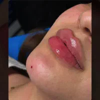 جشنواره تابستانه تزریق ژل و بوتاکس