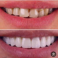 دندانسازی و دندان مصنوعی|خدمات آرایشگری و زیبایی|تبریز, |دیوار