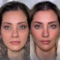 ژل۵۳۰ بوتاکس۴۸۰ فیلر توسط پزشک باتضمین پزشک متخصص