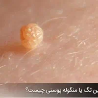 درمانhpvریشه ای زگیل تناسلی زیگیل خال میخچه بواسیر|خدمات آرایشگری و زیبایی|تهران, تهرانپارس غربی|دیوار