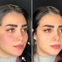 چند نفر مدل برای تزریق بوتاکس روز پنجشنبه فوری