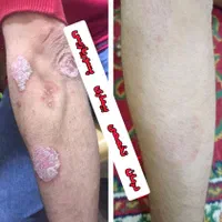 درمان گیاهی بیماری پیسی وپسوریازیس|خدمات آرایشگری و زیبایی|مشهد, حرم مطهر رضوی|دیوار