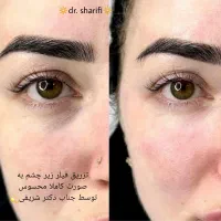 جشنواره ۵۰ درصدی ژل و بوتاکس توسط جناب دکتر شریفی|خدمات آرایشگری و زیبایی|قم, بلوار امین و ساحلی|دیوار