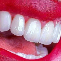 کامپوزیت دندان سارمکو کاریزما باقیمت استثنایی