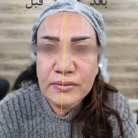 (کلینیک دنا) تنها هایفو۱۲بعدی یاسوج|خدمات آرایشگری و زیبایی|یاسوج, |دیوار