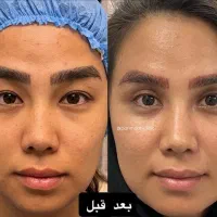 بلفاروپلاستی، پاک کردن تتو، ژل لب، وایتنینگ پوست|خدمات آرایشگری و زیبایی|باقرشهر, |دیوار
