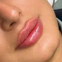 تزریق فیلر و بوتاکس پی آرپی تزریق چربی درکلینیک
