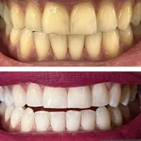 بلیچینگ دندان با نصف قیمت