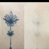 لیزر تتو های قدیمی تتوی صورت و بدن فقط ۵۰۰|خدمات آرایشگری و زیبایی|فولادشهر, C3|دیوار