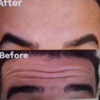 لیزر موهای زائدالکساندرایت‌کندلاآمریکایی‌اصل|خدمات آرایشگری و زیبایی|اندیشه, اندیشه فاز ۱|دیوار