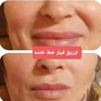 آموزش خدمات زیبایی  تزریق ژل .فیلر .بوتاکس .چربی|خدمات آموزشی|رشت, گلسار|دیوار