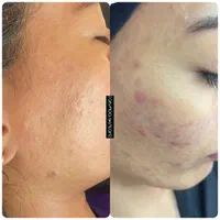 فیشال و پاکسازی پوست صدرا