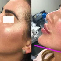 تزریق ژل و بوتاکس و لیزر موهای زائد|خدمات آرایشگری و زیبایی|شیراز, آزادگان|دیوار