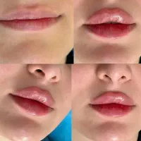 تزریق ژل و بوتاکس(اقساطی) توسط پزشک همه روزه