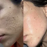 از بین بردن لک و جای جوش فرورفته صورت گچساران|خدمات آرایشگری و زیبایی|دهدشت, |دیوار