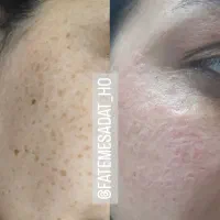 حذف دائمی کک و مک|خدمات آرایشگری و زیبایی|تربت جام, المهدی|دیوار