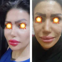 ژل بوتاکس و انزیم|خدمات آرایشگری و زیبایی|شیراز, لشکری‎|دیوار