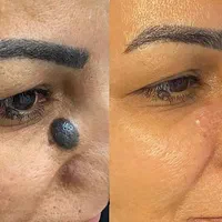 خال،زگیل،میخچه،جوانسازی، رفع چین چروک