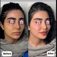 ژل بوتاکس عمل بینی ساکشن چربی در کلینیک بهنود|خدمات آرایشگری و زیبایی|تبریز, |دیوار