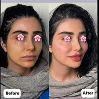 ژل بوتاکس عمل بینی ساکشن چربی در کلینیک بهنود|خدمات آرایشگری و زیبایی|تبریز, |دیوار