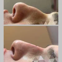 مطب پزشک.ژل وبوتاکس.لیفت بانخ.فیلربینی ژل آلت|خدمات آرایشگری و زیبایی|قم, دورشهر|دیوار