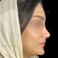 عمل جراحی بینی فقط ۳۵ میلیون/لیفت صورت|خدمات زیبایی و سلامت|کرج, فاز ۲ مهرشهر|دیوار