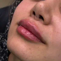 تزریقات فیلر و بوتاکس توسط پزشک|خدمات آرایشگری و زیبایی|تهران, جوادیه|دیوار