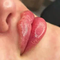 مدل ژل لب روسی نخ انزیم فیلر بوتاکس زاویه فیلربادی