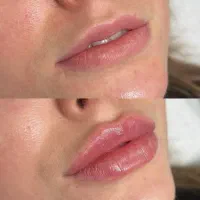 ۷۸٪ تخفیف بلک فرایدی برای تزریق ژل توسط پزشک