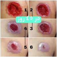 کارشناس زخم و پانسمان